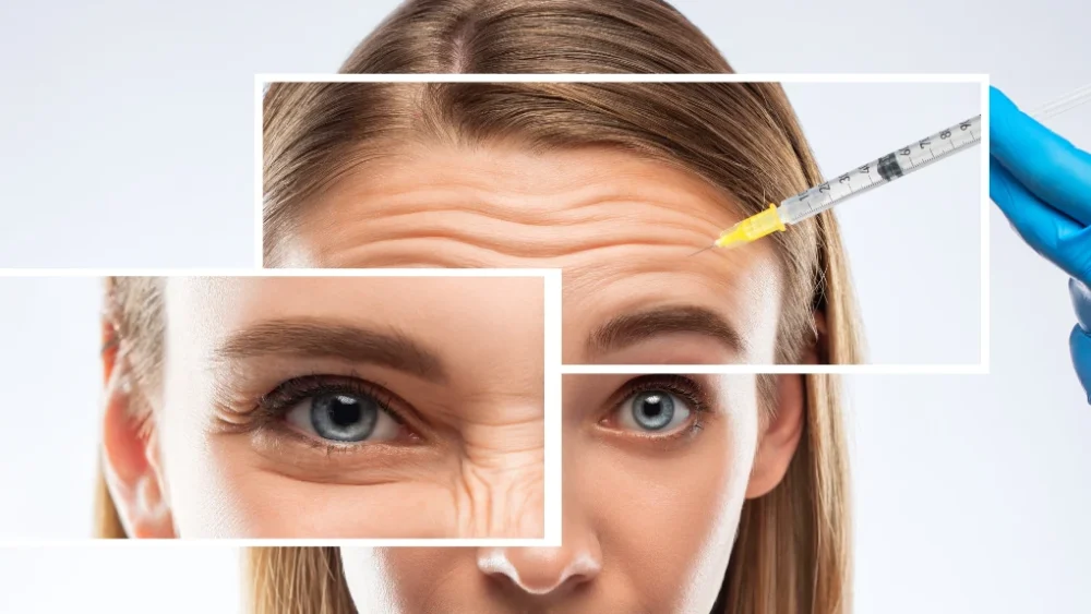 anti-wrinkle injections