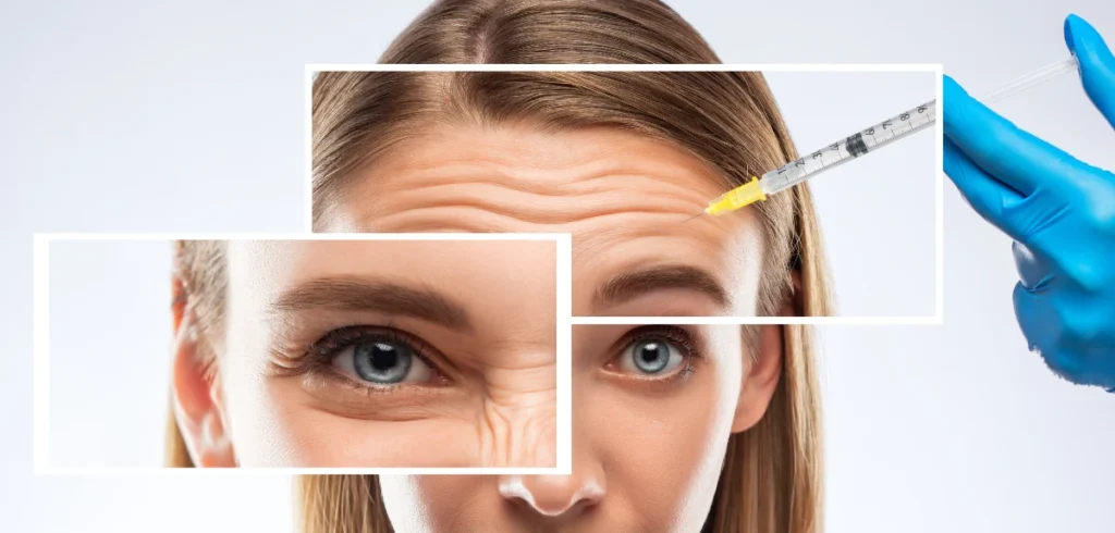 anti-wrinkle injections